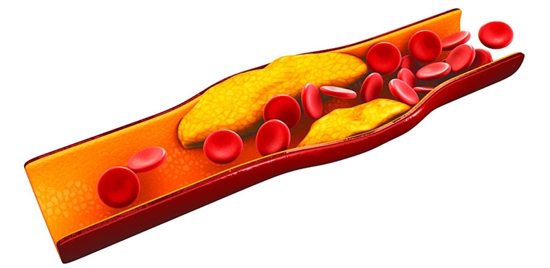 Arterial plaques picture