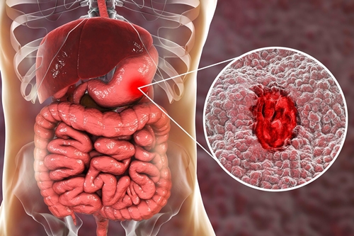 Gastric ulcer picture