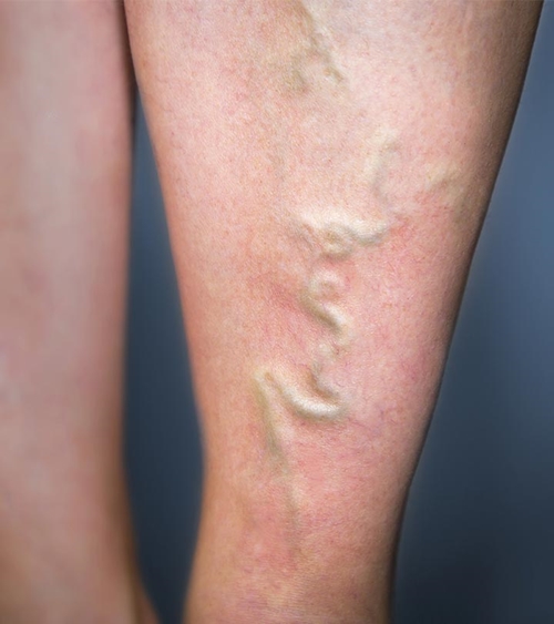 Phlebitis picture