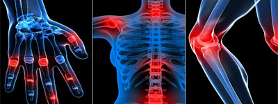 Rheumatism picture