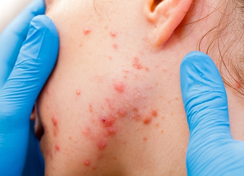 Skin condition picture