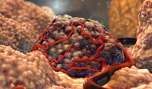 Tumor picture