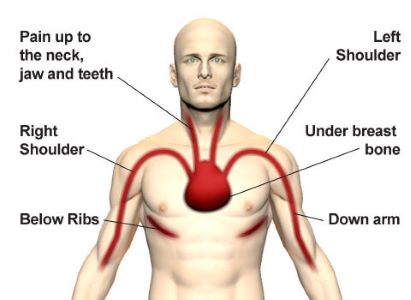 Angina picture