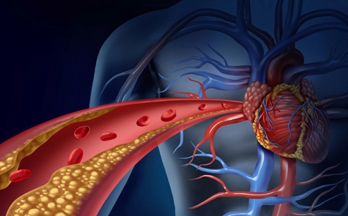 Cholesterol picture