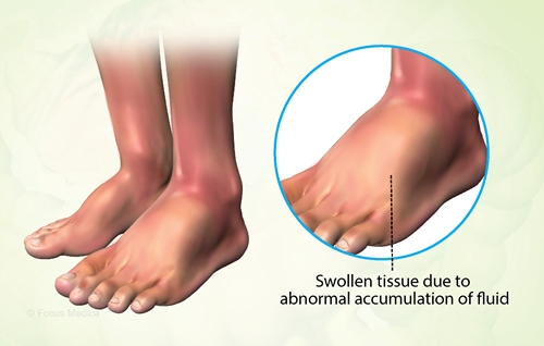 Edema picture