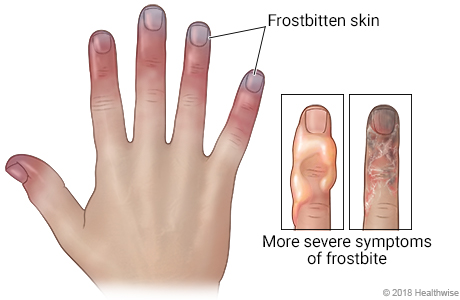 Frostbite picture