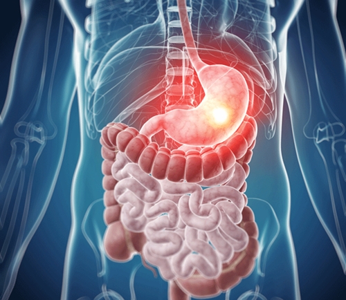 Gastritis picture