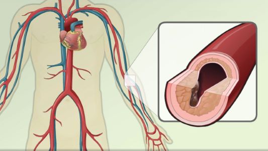 Hardening of the arteriers picture
